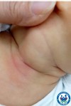 PHỤC HỒI CHỨC NĂNG XƠ HOÁ CƠ ỨC ĐÒN CHŨM Ở TRẺ EM