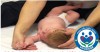 Hình ảnh trẻ sơ sinh liệt đám rối thần kinh cánh tay