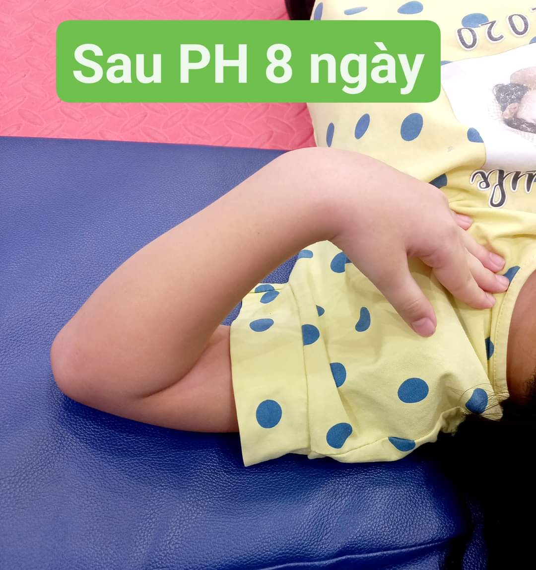 Sau tập PHCN 08 ngày